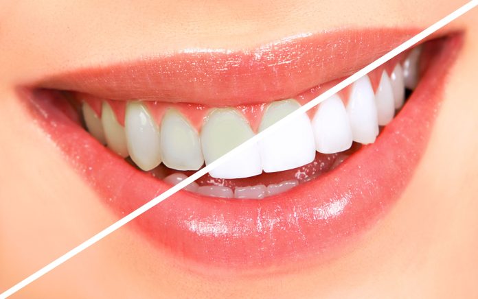 teeth whitening products wholesale