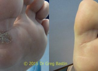 wart removal