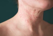 What is atopic dermatitis, and how can you treat it?