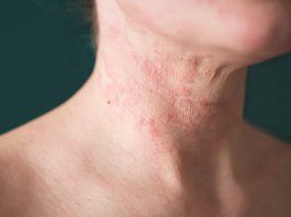 What is atopic dermatitis, and how can you treat it?