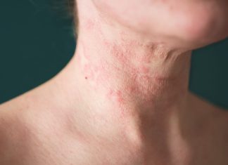 What is atopic dermatitis, and how can you treat it?
