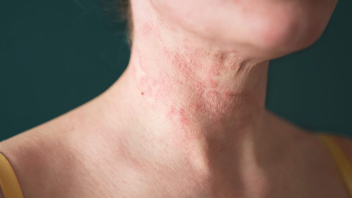 What is atopic dermatitis, and how can you treat it?